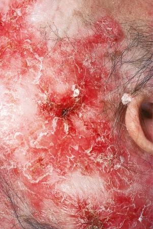 Fig. 17.8, Discoid lupus erythematosus: there is alopecia with very marked scarring.