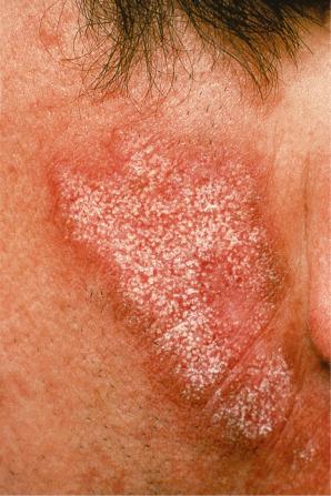 Fig. 17.10, Discoid lupus erythematosus: close-up view showing follicular plugging.