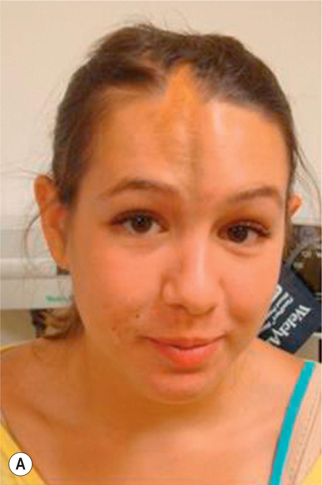 Figure 27.5, (A,B) A 13-year-old girl with typical en coup de sabre lesion affecting the forehead and scalp with resultant skull depression.