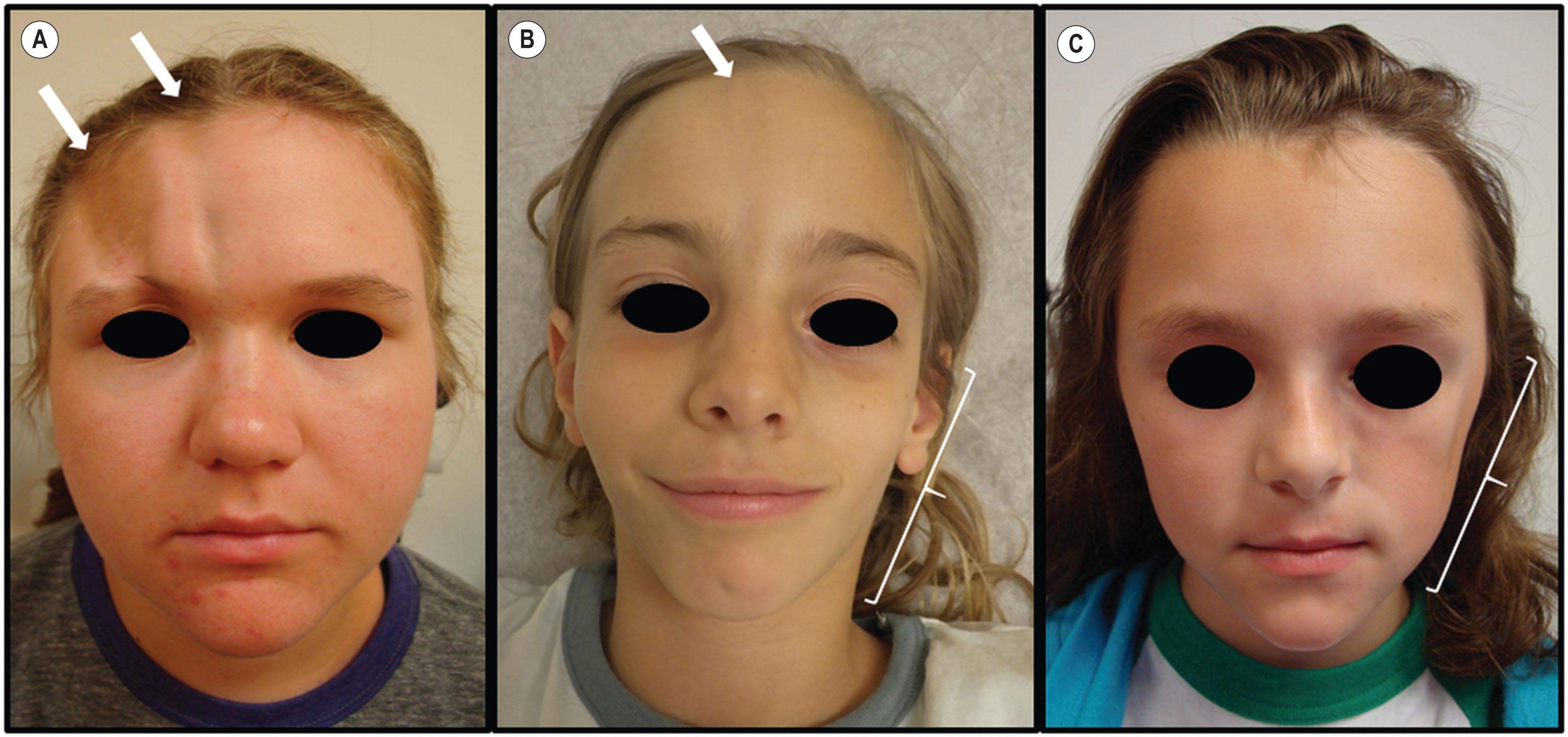 Figure 27.2, Phenotypic spectrum of Parry–Romberg syndrome (progressive hemifacial atrophy) and scleroderma en coup de sabre (ECDS). (A) Patient with two right-sided ECDS lesions (hyperpigmentation, dermal atrophy, subcutaneous atrophy) of the forehead extending to the superior orbital rim. (B) Patient with right-sided ECDS lesion (hyperpigmentation, dermal atrophy) of the forehead extending inferiorly to the nasal tip and left-sided PRS involvement of the zygomatic and mandibular areas. (C) Patient with left-sided PRS involvement of the infraorbital, zygomatic, and mandibular areas.