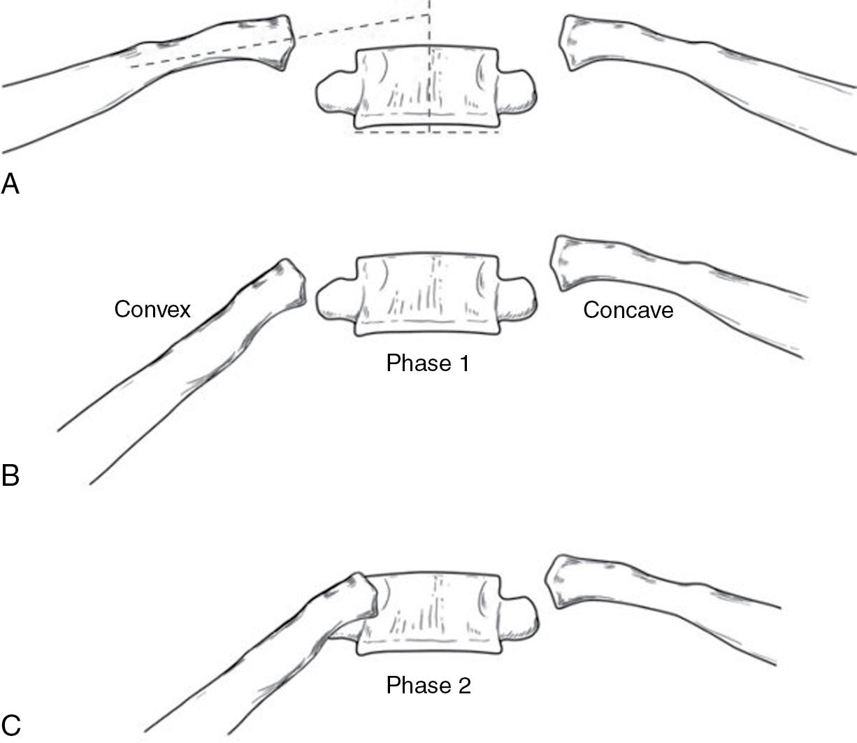 Fig. 38.1, The rib-vertebral angle difference and rib phase. (A) The rib-vertebral angle is determined by a line perpendicular to the endplate of the apical vertebra and a line drawn along the center of the rib. (B) Phase 1, the convex rib does not overlap the vertebral body. (C) Phase 2, the convex rib overlaps the vertebral body.