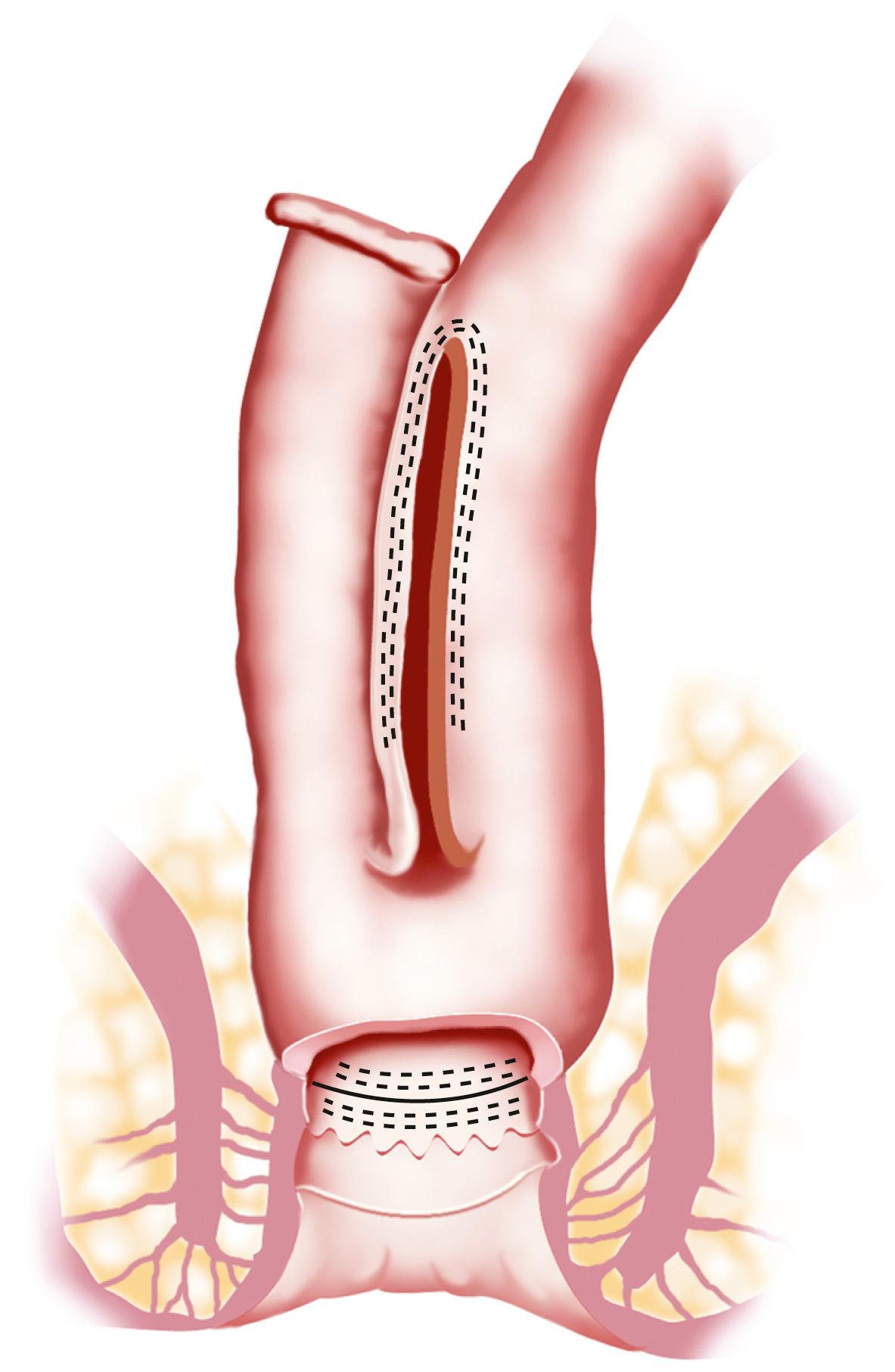 Fig. 117.3, The anatomy of the most commonly used type of ileal pouch, the J-pouch. A pouch approximately 12 to 15 cm long is constructed by opening the common wall between the 2 limbs of the J formed from the distal terminal ileum. The apex is then anastomosed to the upper anal canal.