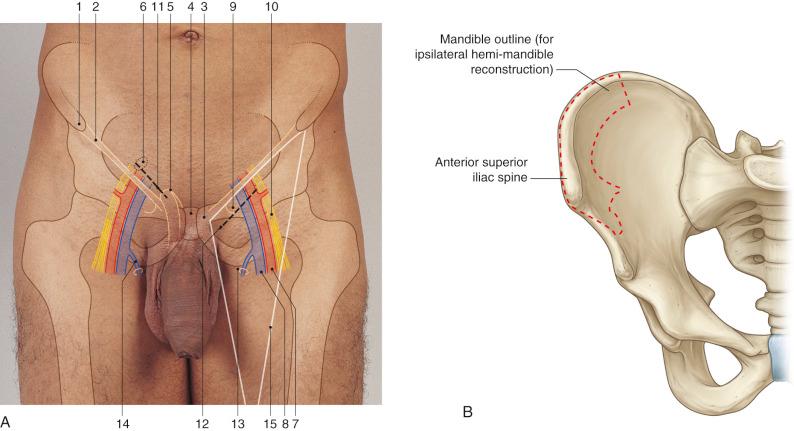 Figure 42.2, (A) Anatomic landmarks. 1. Anterior superior iliac spine. 2. Inguinal ligament. 3. Pubic tubercle. 4. Symphysis pubis. 5. Superficial inguinal ring. 6. Deep inguinal ring. 7. Femoral artery. 8. Femoral vein. 9. Femoral canal. 10. Femoral nerve. 11. Inguinal hernia incision. 12. Femoral hernia incision. 13. Saphenous opening. 14. Long saphenous vein. 15. Femoral triangle. (B) Outline of osteotomies on iliac crest bone needed for ipsilateral hemi-mandible reconstruction.