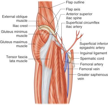 Figure 42.3, External anatomy showing surrounding musculature, inguinal ligament, and inguinal blood vessels. The flap outline and medial extension needed to dissect the pedicle are indicated by a broken line.