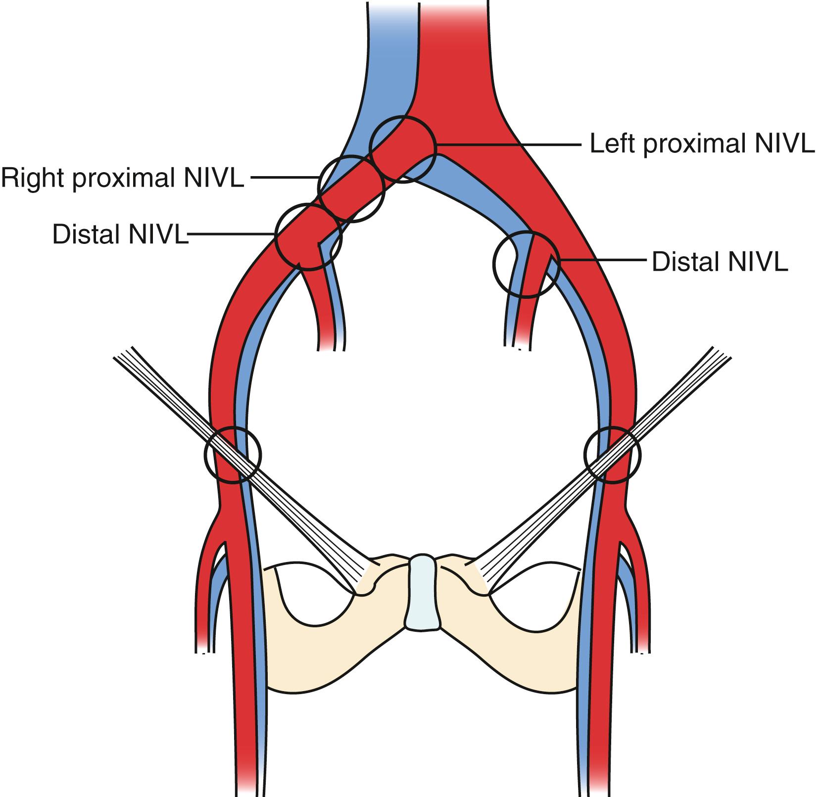 Figure 161.1, Common Sites of Iliac Vein Stenosis Seen on Intravascular Ultrasound Examination.