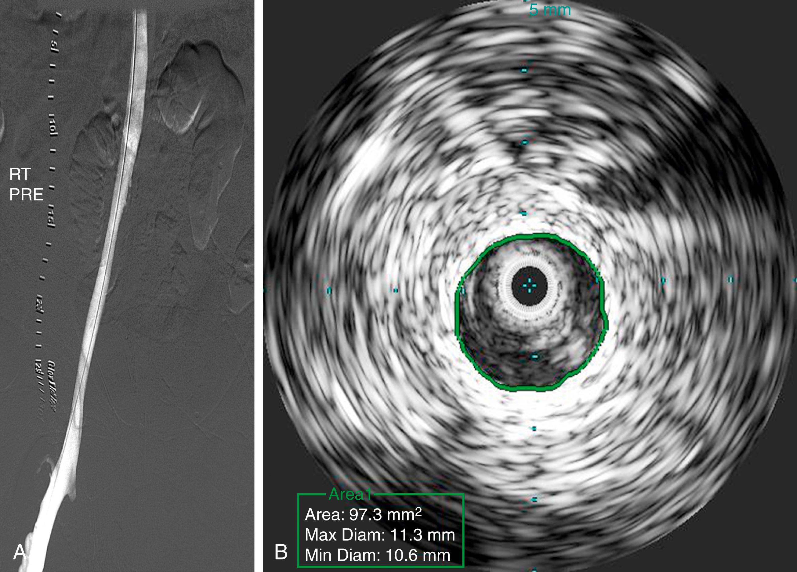 Figure 161.2, Rokitansky Stenosis.