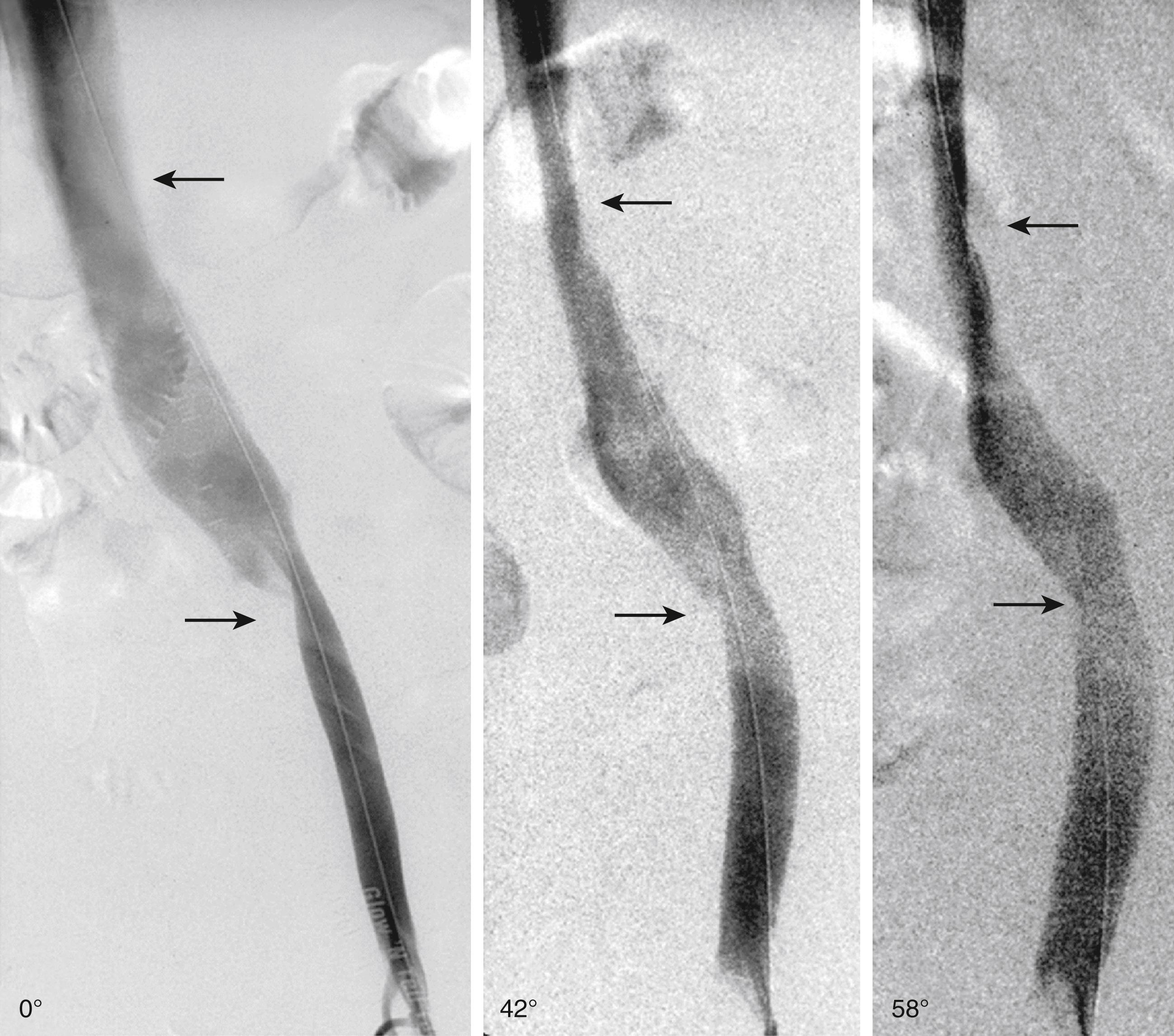 Figure 161.4, Nonthrombotic iliac vein lesions are often two-dimensional rather than circumferential. In the example shown, the proximal lesion is not apparent on frontal projection (0°) but is revealed on lateral projections (←). The distal lesion apparent in the frontal view becomes hidden in oblique and lateral projections (→). The level of iliac confluence is not readily apparent in the frontal view.