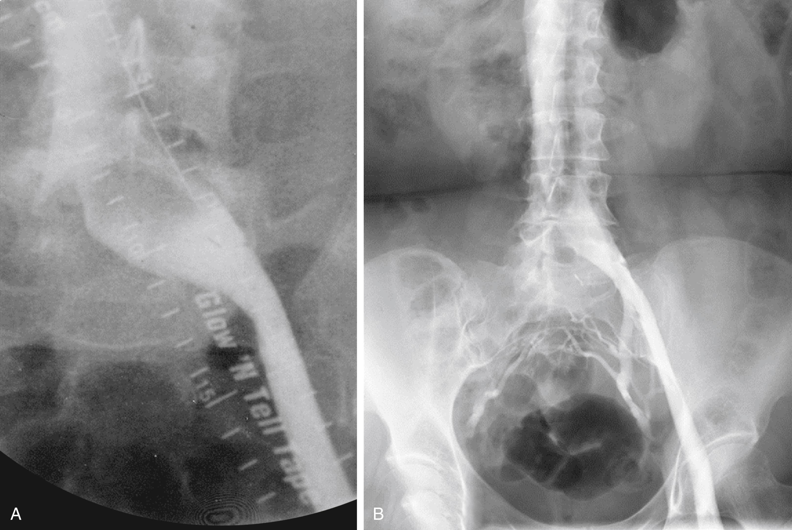 Figure 161.5, Venographic appearance of nonthrombotic iliac vein lesion: “island”-like appearance of the terminal common iliac vein ( A ). “Pancaking” ( B ) with collaterals.