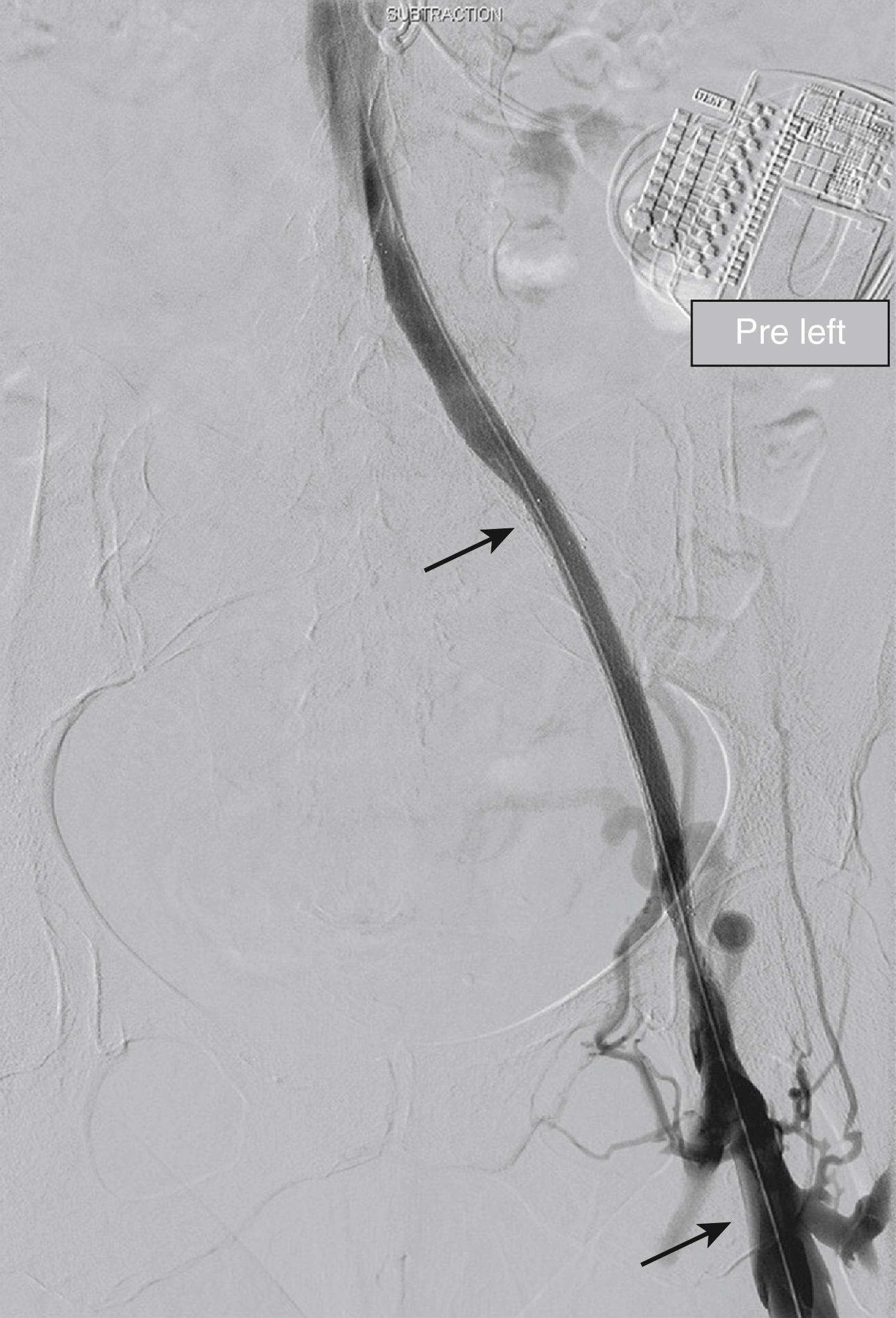 Figure 161.6, An undersized 8-mm diameter stent (optimum 16 to 18 mm) was placed in the iliac vein (proximal arrow) . Note the caliber of the stent is smaller than the common femoral vein (distal arrow) . Placing an undersized stent results in an iatrogenic stenosis, which is difficult to correct.