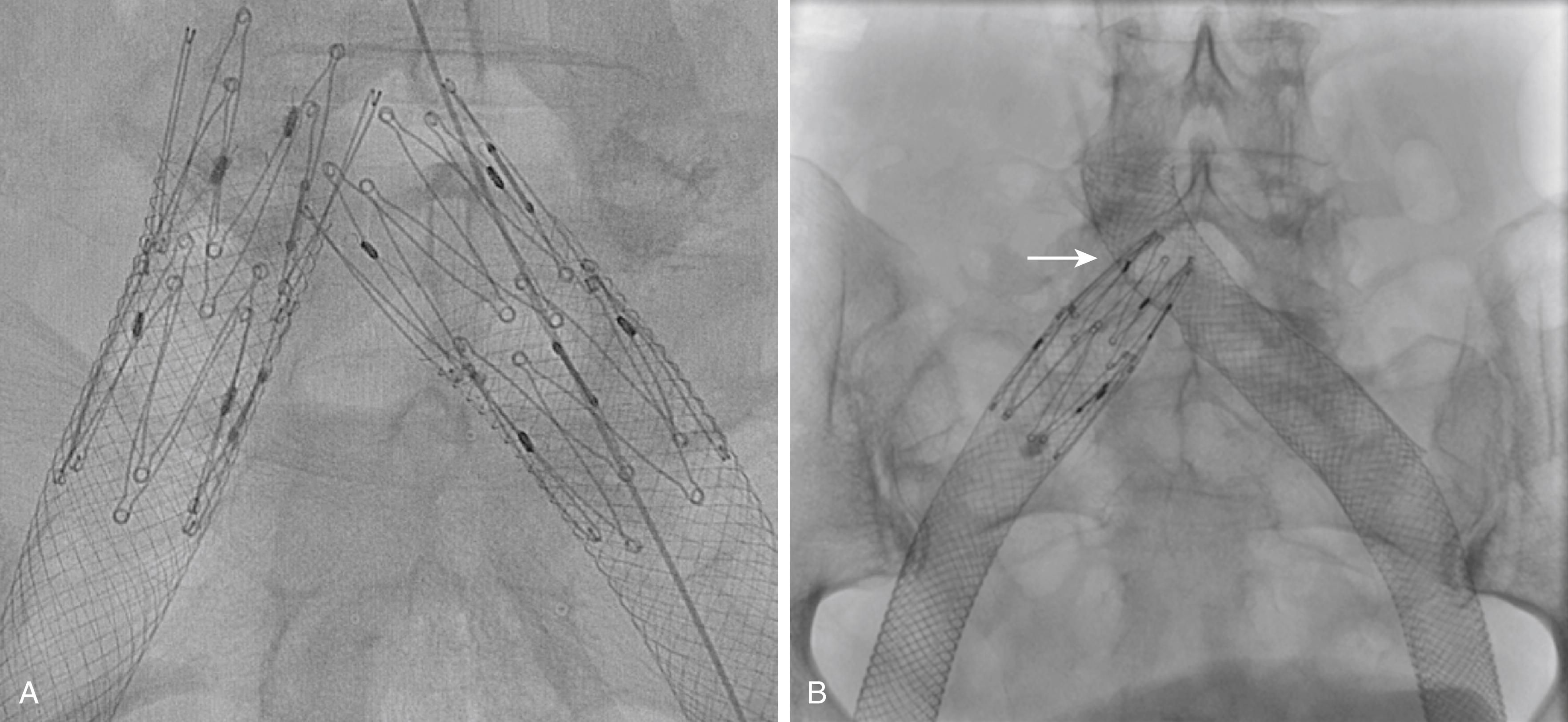 Figure 161.7, Z-Stent Inferior Vena Cava Extension of the Wallstent Stack.