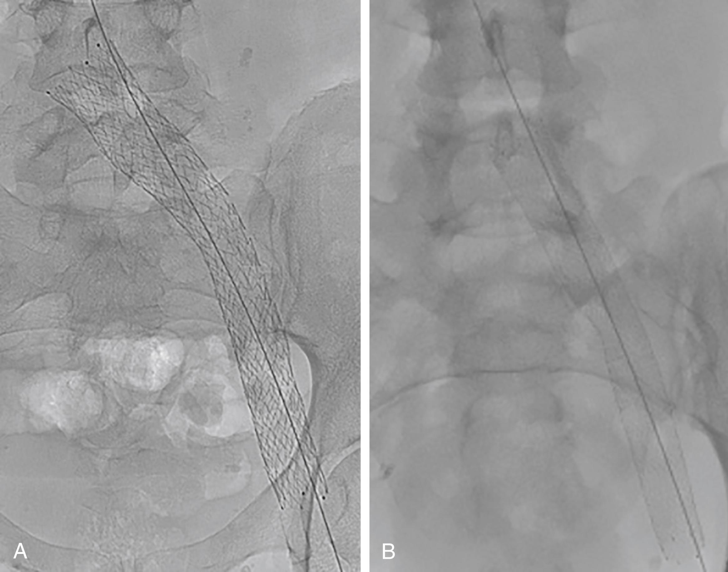 Figure 161.8, Dedicated venous stents currently approved for use by the FDA. ( A ) Vici (Boston Scientific, Marlborough, MA). ( B ) Venovo (Bard, Tempe, AZ).