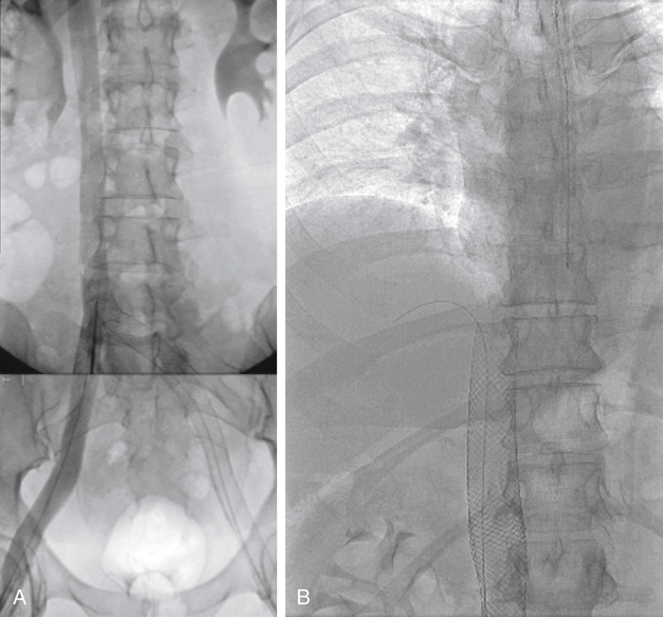 Figure 161.9, Extensive recanalization of chronic total occlusions involving the inferior vena cava and both iliac veins. The stent stack extends to the common femoral vein below the inguinal ligament bilaterally ( A ). Stent erosions and fractures involving the Wallstent crossing joint creases are rare in venous applications. In ( B ), the Wallstent stack extends almost to the atrium.