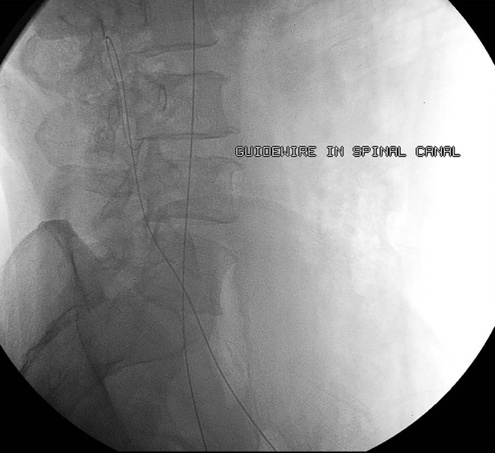 Figure 161.10, Guidewire in the spinal canal visualized on lateral fluoroscopic views.