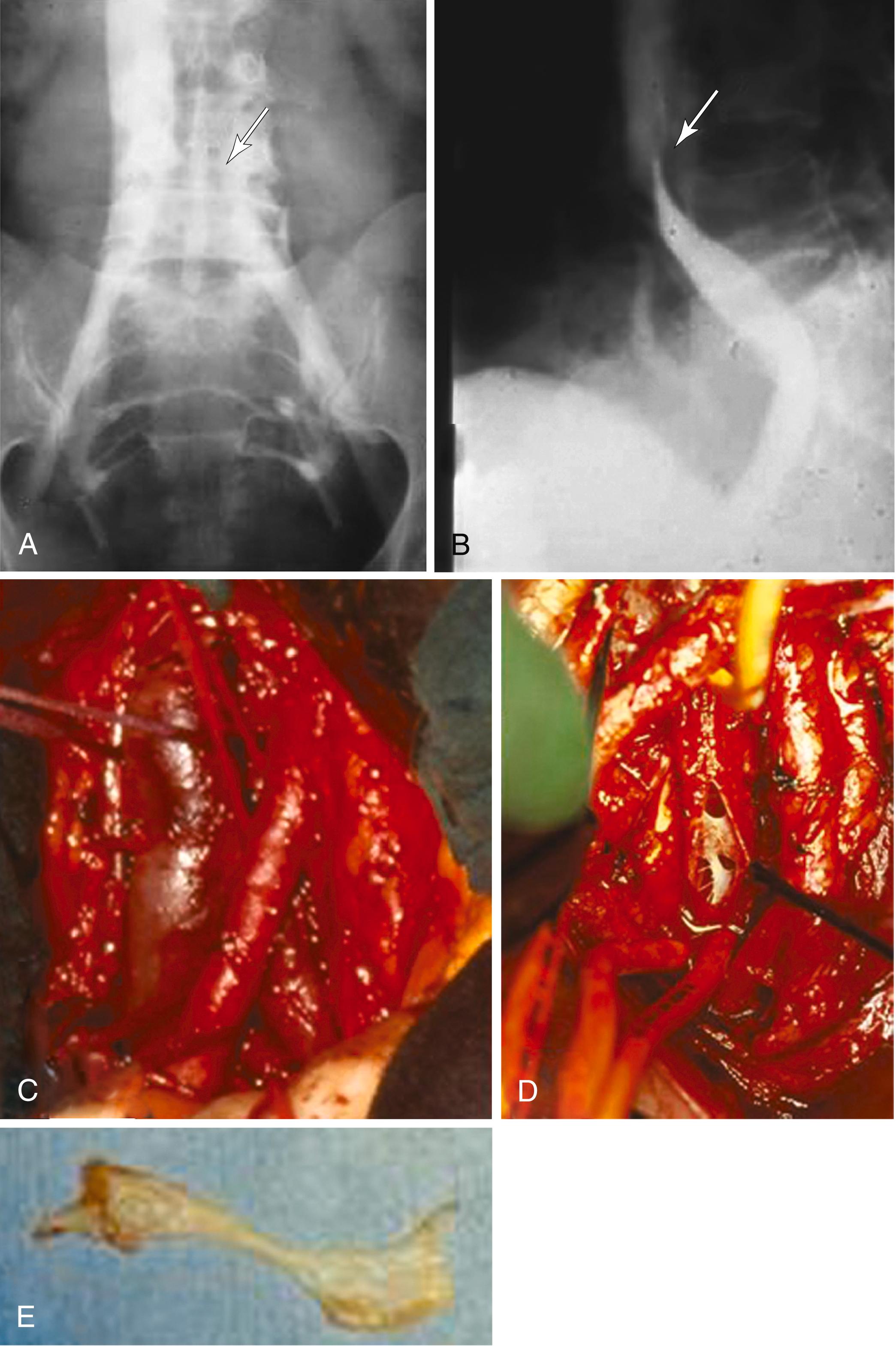 Figure 160.1, Compression of the Left Common Iliac Vein by the Right Common Iliac Artery (May–Thurner Syndrome).