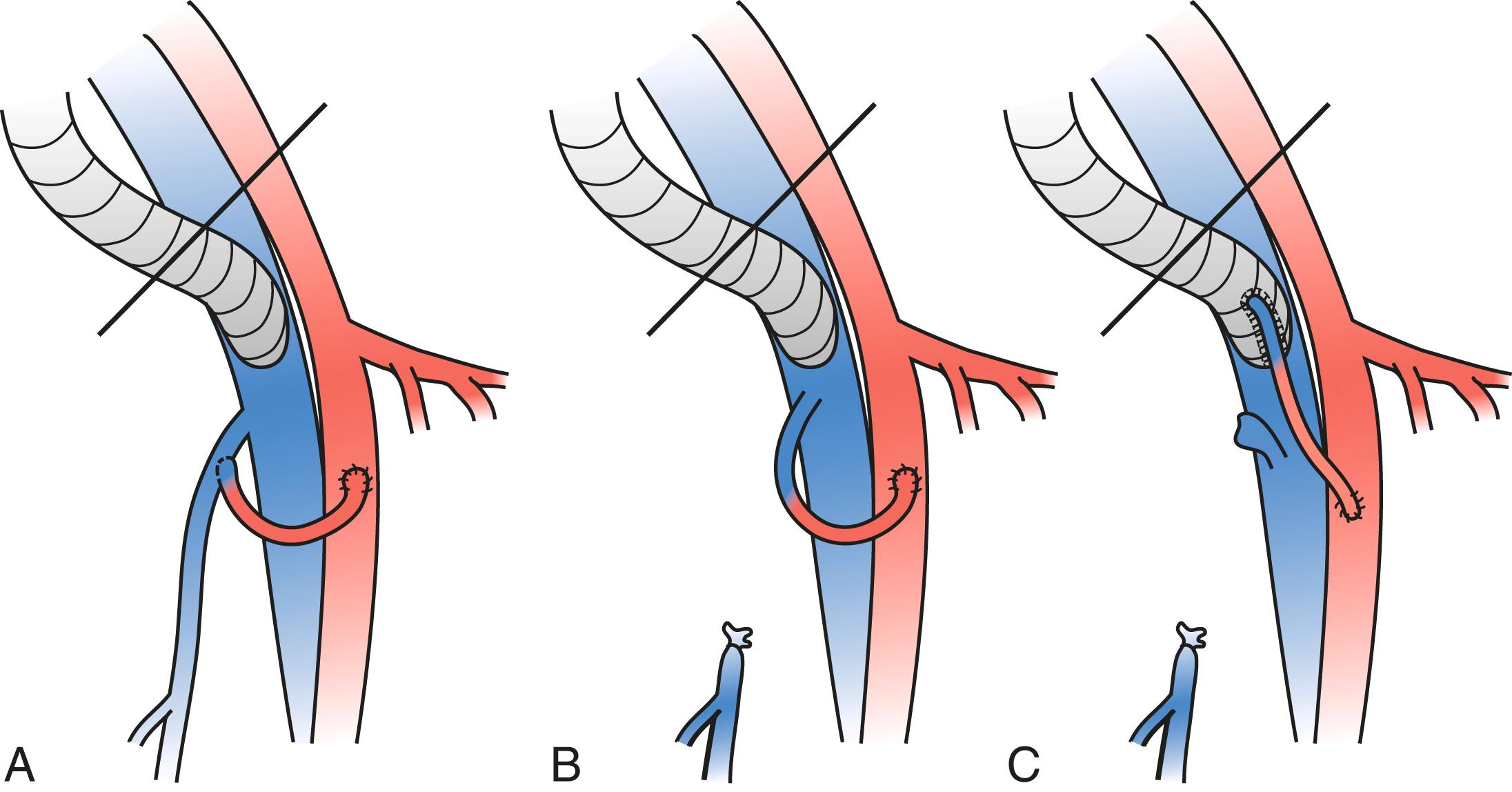 Figure 160.2, Different Types of Arteriovenous Fistulae Placed Distally to a Ringed Expanded Polytetrafluoroethylene (ePTFE) Femoral Venous Graft.