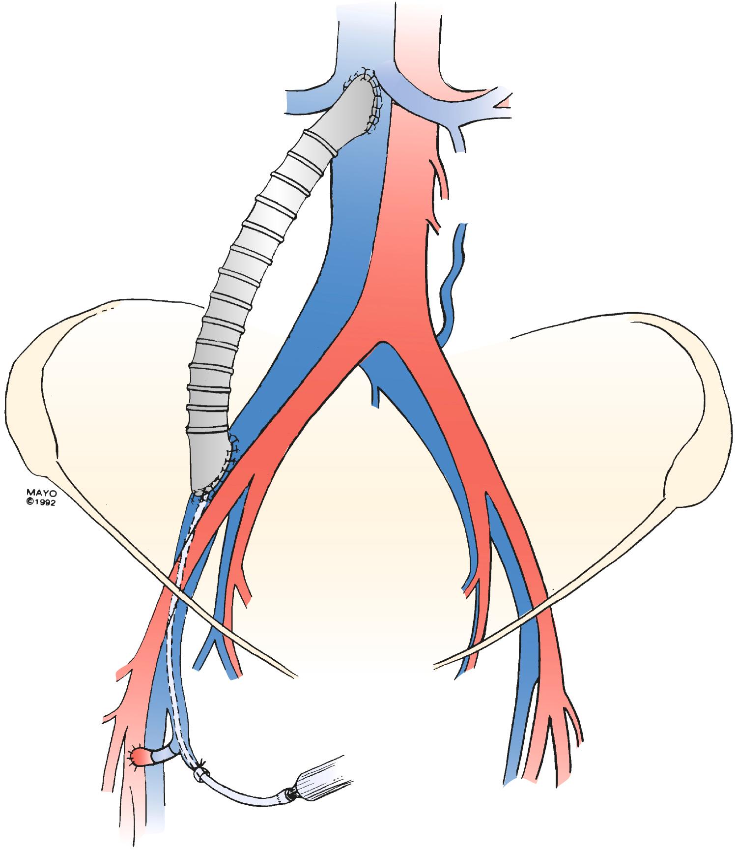 Figure 160.3, Illustration of a right iliac vein/inferior vena caval externally supported polytetrafluoroethylene graft. Note the arteriovenous fistula at the right groin and a 20-gauge catheter, which is introduced through a tributary of the saphenous vein for perioperative heparin infusion.