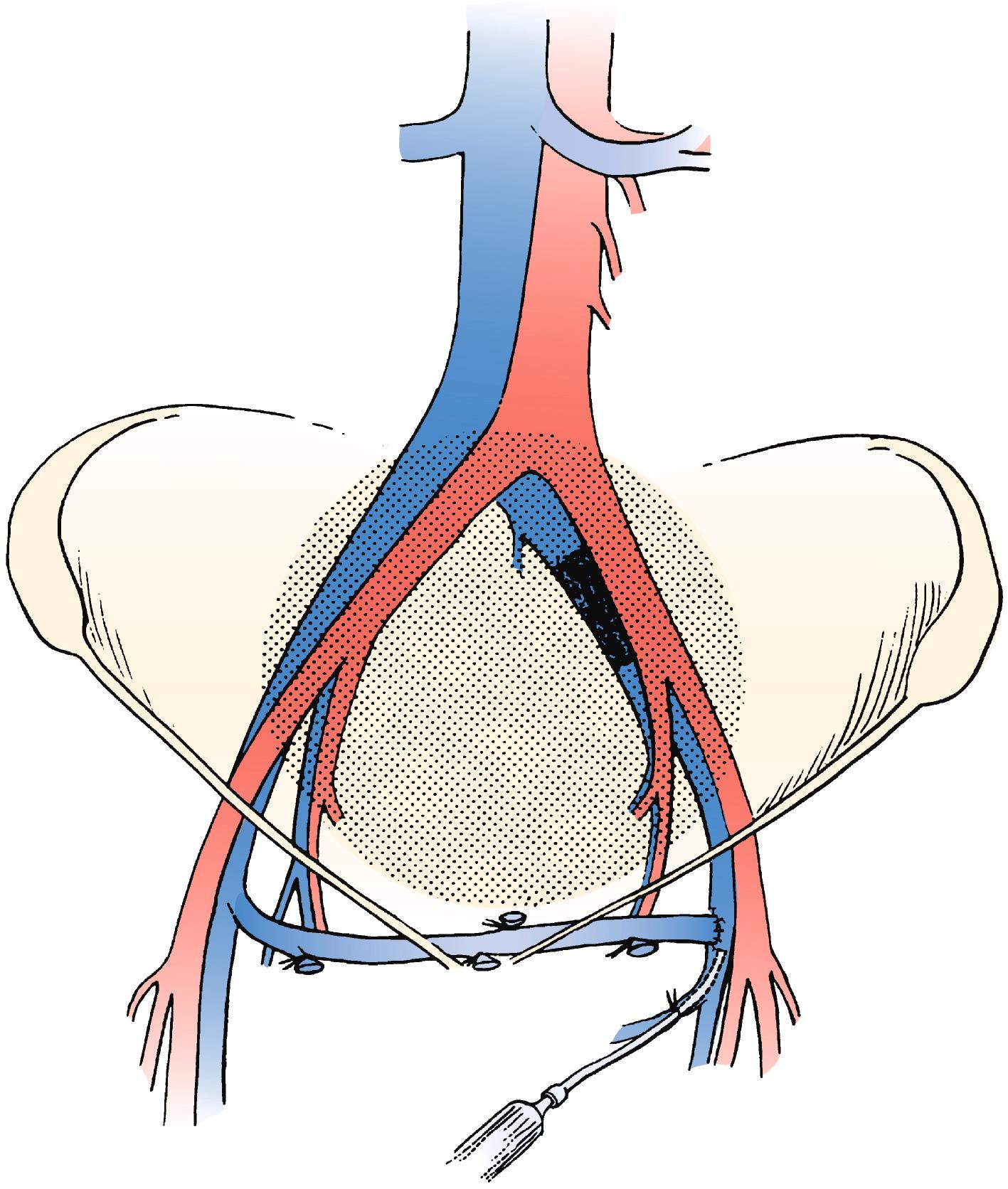 Figure 160.4, Left-to-right femorofemoral venous bypass (Palma procedure) for left common iliac vein obstruction. A small polyethylene catheter can be placed through a side branch of the greater saphenous vein for immediate perioperative heparinization to improve chances of patency.