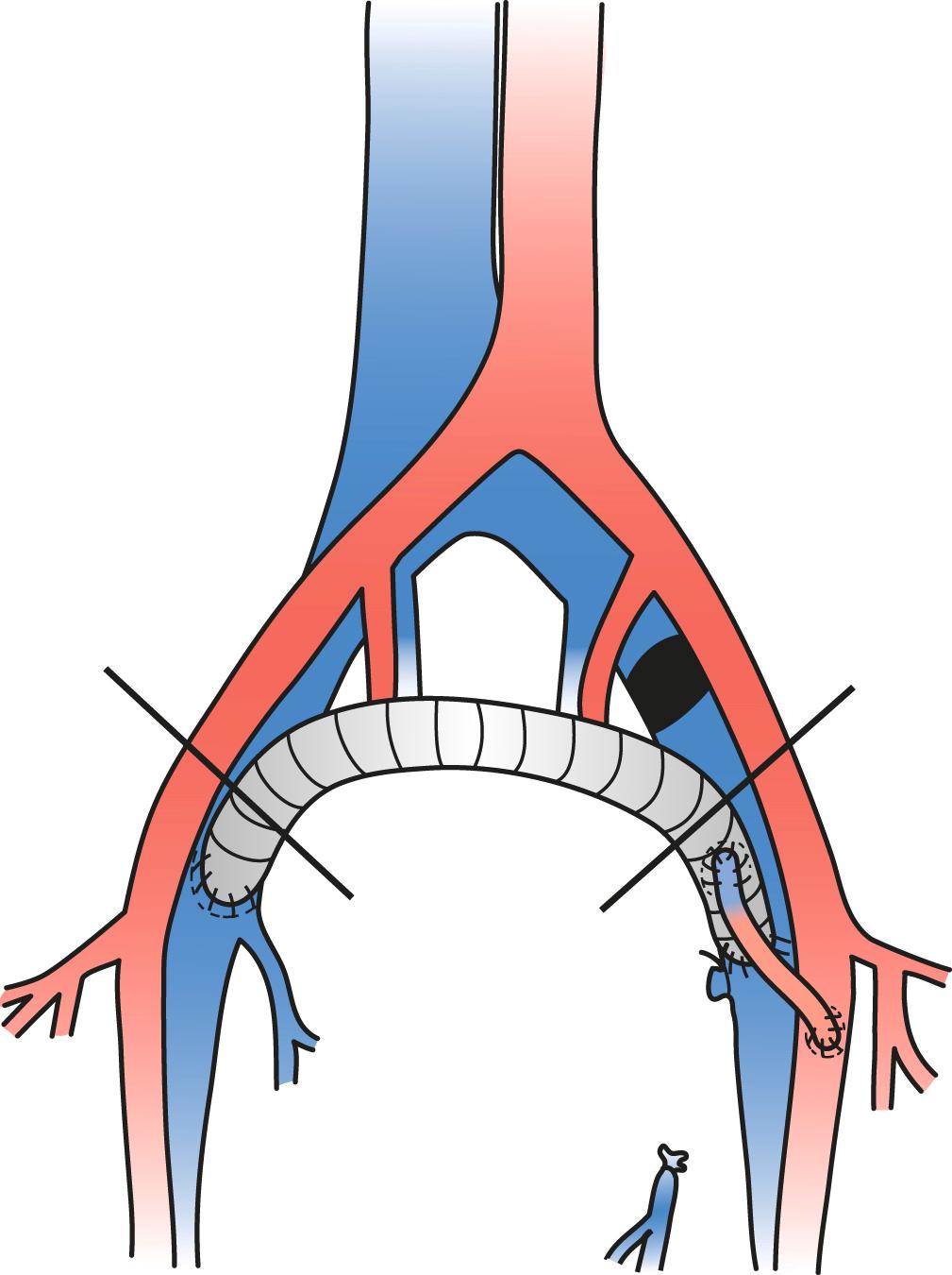 Figure 160.6, Diagram of a right-to-left expanded polytetrafluoroethylene femorofemoral crossover vein graft (Palma procedure). Note the fistula in the right groin, extending from the proximal superficial femoral artery to the hood of the graft.