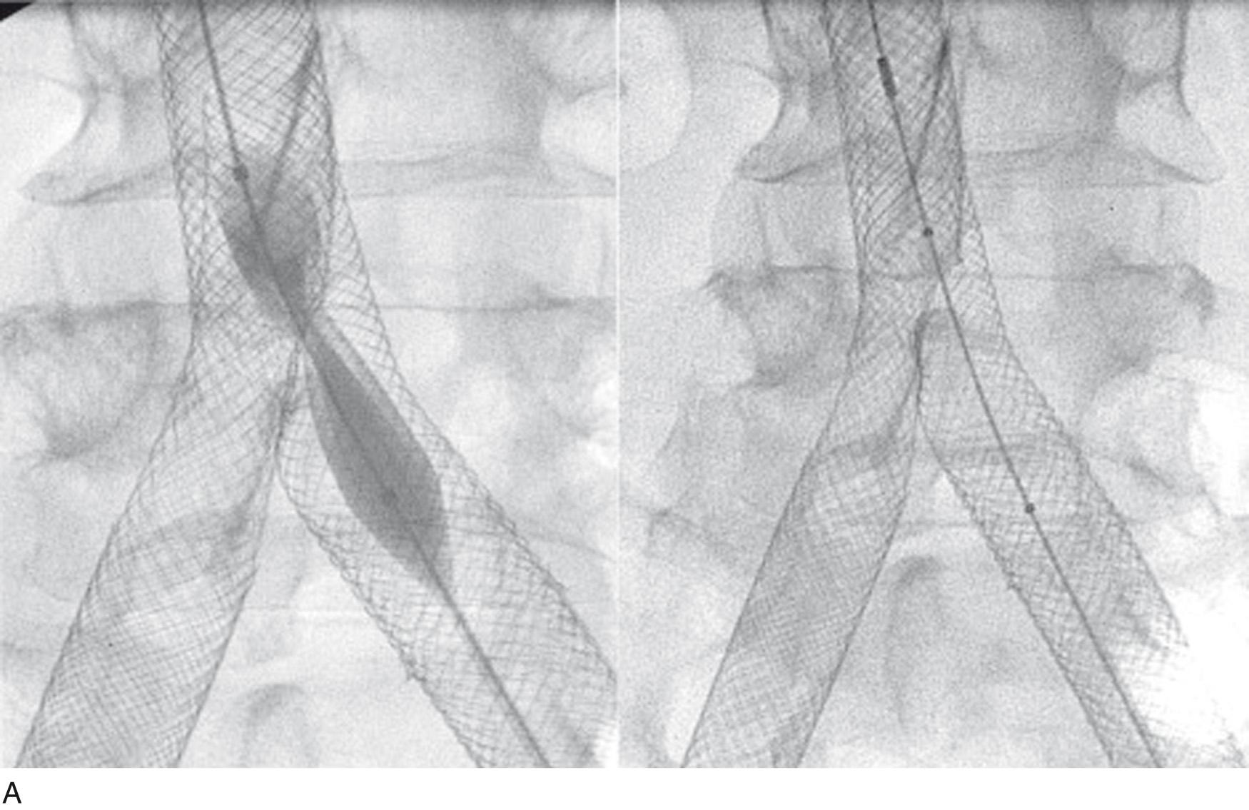 Fig. 18.11, (A) Fenestration of a stent, which is placed across the outflow of one stented limb after an inverted Y fenestration. Left, a balloon is placed through the side of the stent and dilated, (right) creating a fenestra allowing unimpeded outflow. (B) The unilateral dilation may sometimes infringe on the previous created window and result in stenosis. Left, it may be useful to perform balloon dilation at the stent confluence by kissing balloon technique to (right) ensure an uninterrupted outflow from both iliac veins. 16