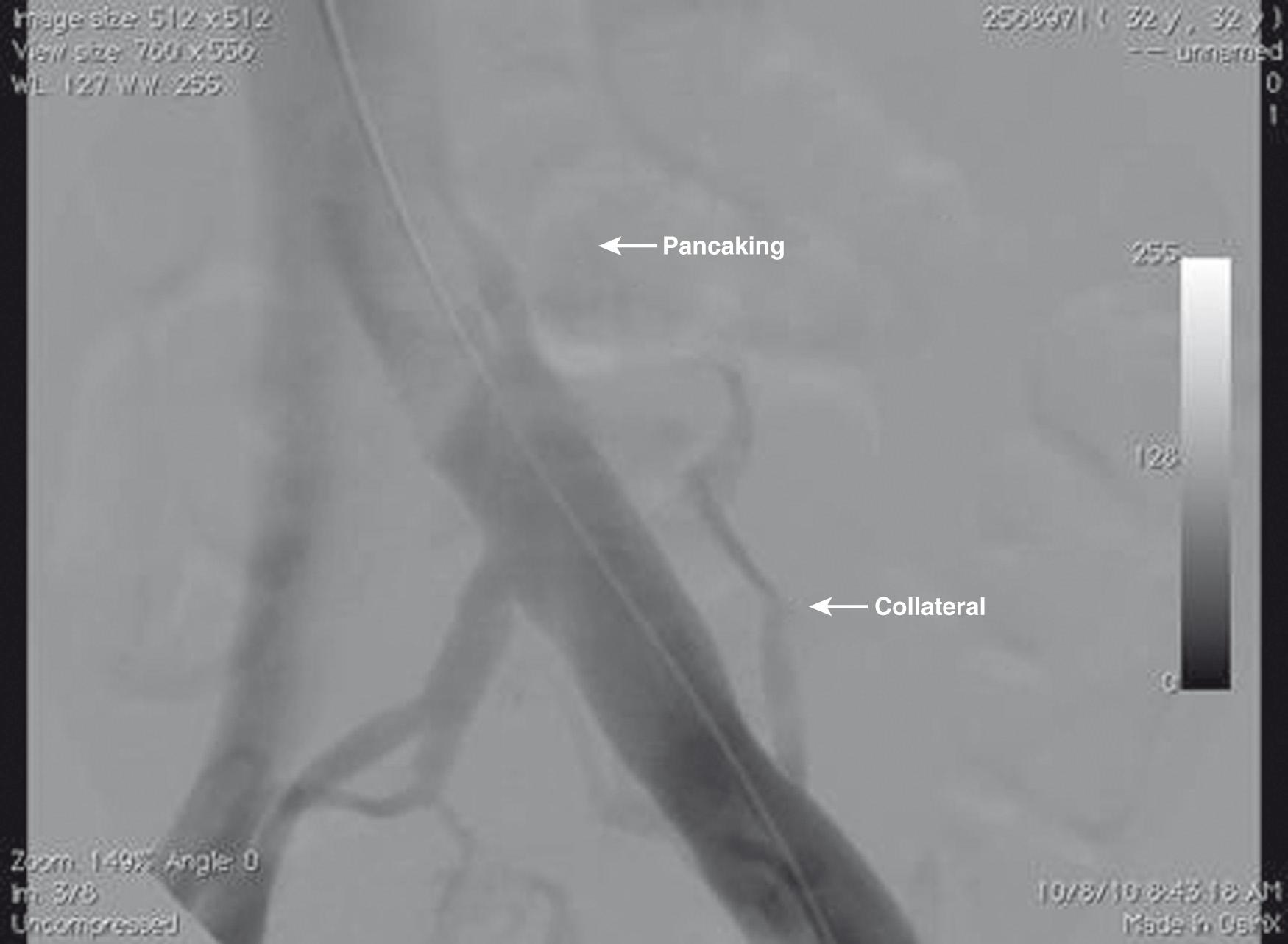 Fig. 18.2, Left iliocaval contrast venography with oblique views. “Pancaking” seen at iliocaval confluence.