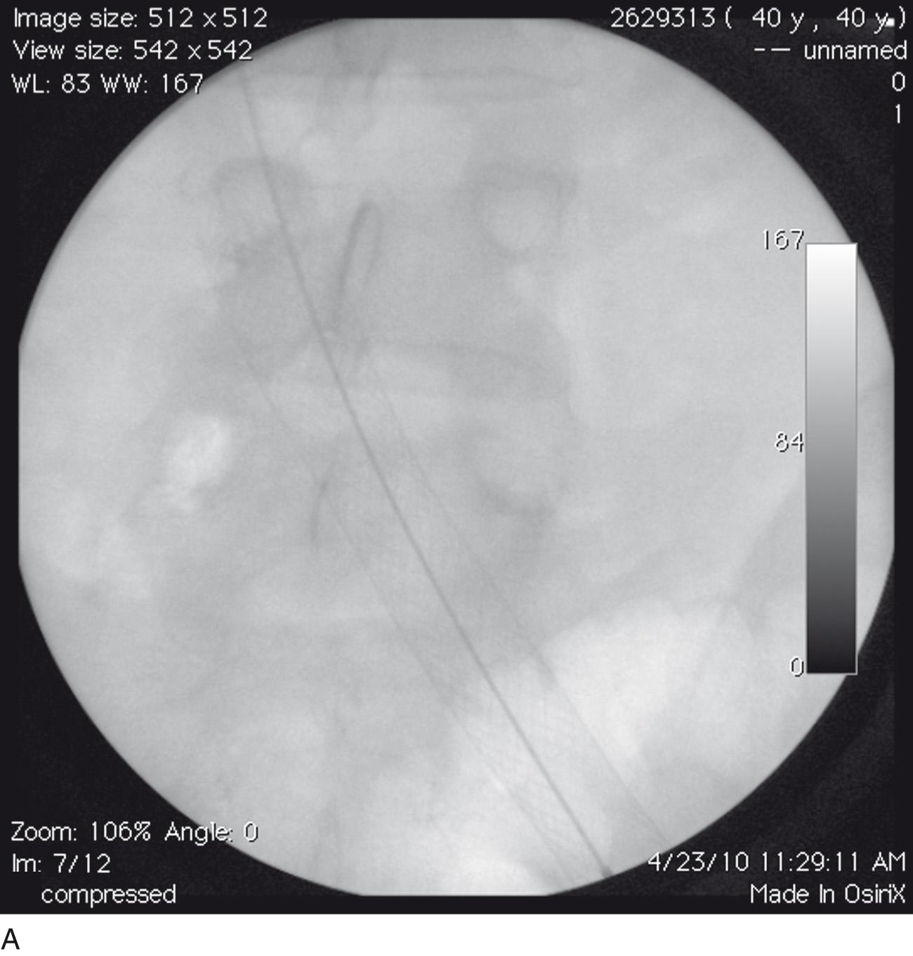 Fig. 18.6, (B) After deployment of proximal 18-mm × 9-cm Wallstent. Proximal stent extends 1 to 2 cm into inferior vena cava.