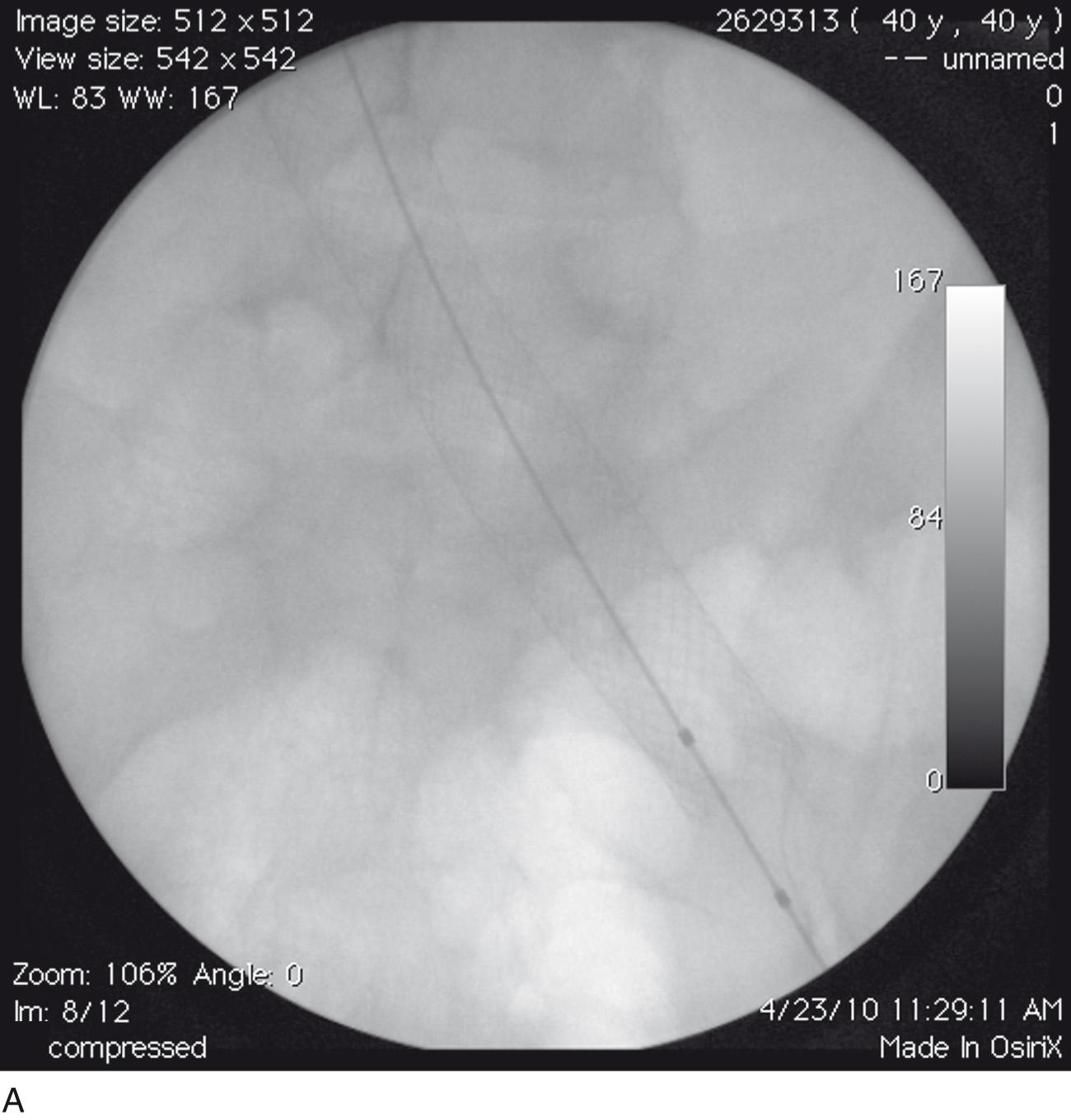 Fig. 18.7, (B) After deployment of second Wallstent (18 mm × 9 cm). Distal aspect of stent extends below inguinal ligament. There is a 3-cm area of stent overlap.