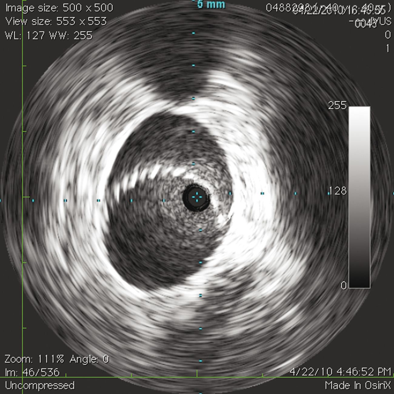 Fig. 18.8, Proximal stent extension into inferior vena cava.