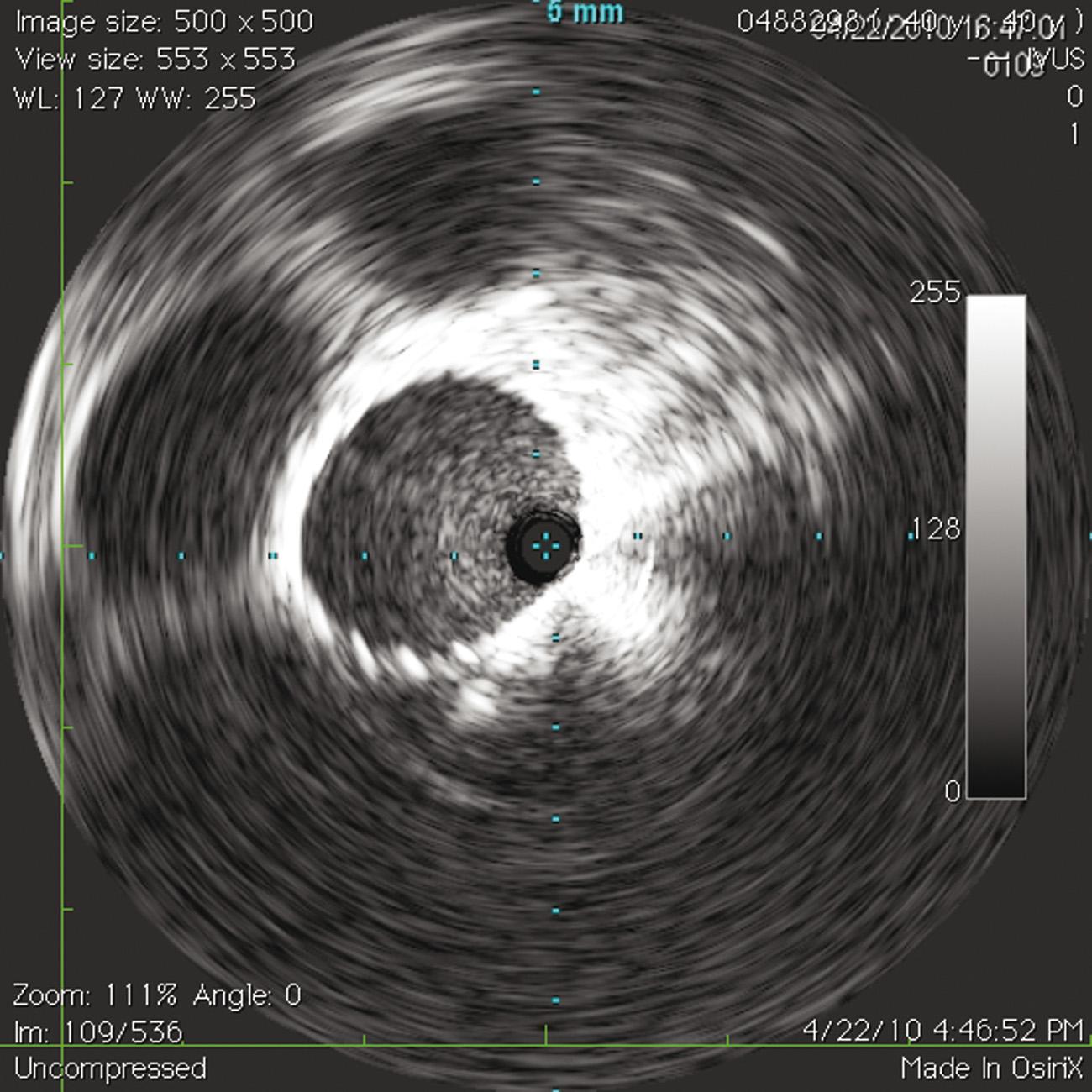 Fig. 18.9, Deployed stent with complete apposition to left common iliac vein wall. Complete obliteration of the stenosis at right common iliac artery compression site.