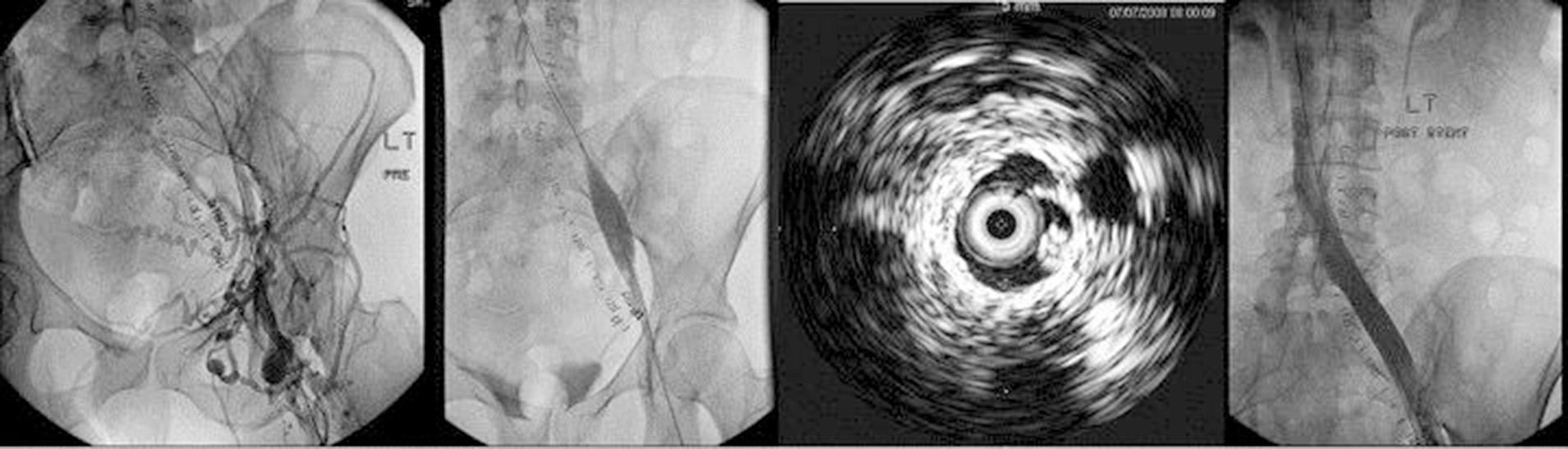 Fig. 18.10, Recanalization of an occluded iliac vein. Left panel, initial venogram. Second panel, aggressive dilatation of the occluded vein and deployment of a slightly oversized stent is required to achieve a recanalized lumen approximating normal anatomy. This poses no bleeding risk. Third panel, intravascular ultrasound examination of the recanalized channel after maximal balloon dilatation invariably shows the glide wire in the middle of the venous channel with intact thick walls. Right panel, completion venogram shows a stented channel of adequate lumen without residual stenoses, good flow, and absence of previously visualized collaterals. 15