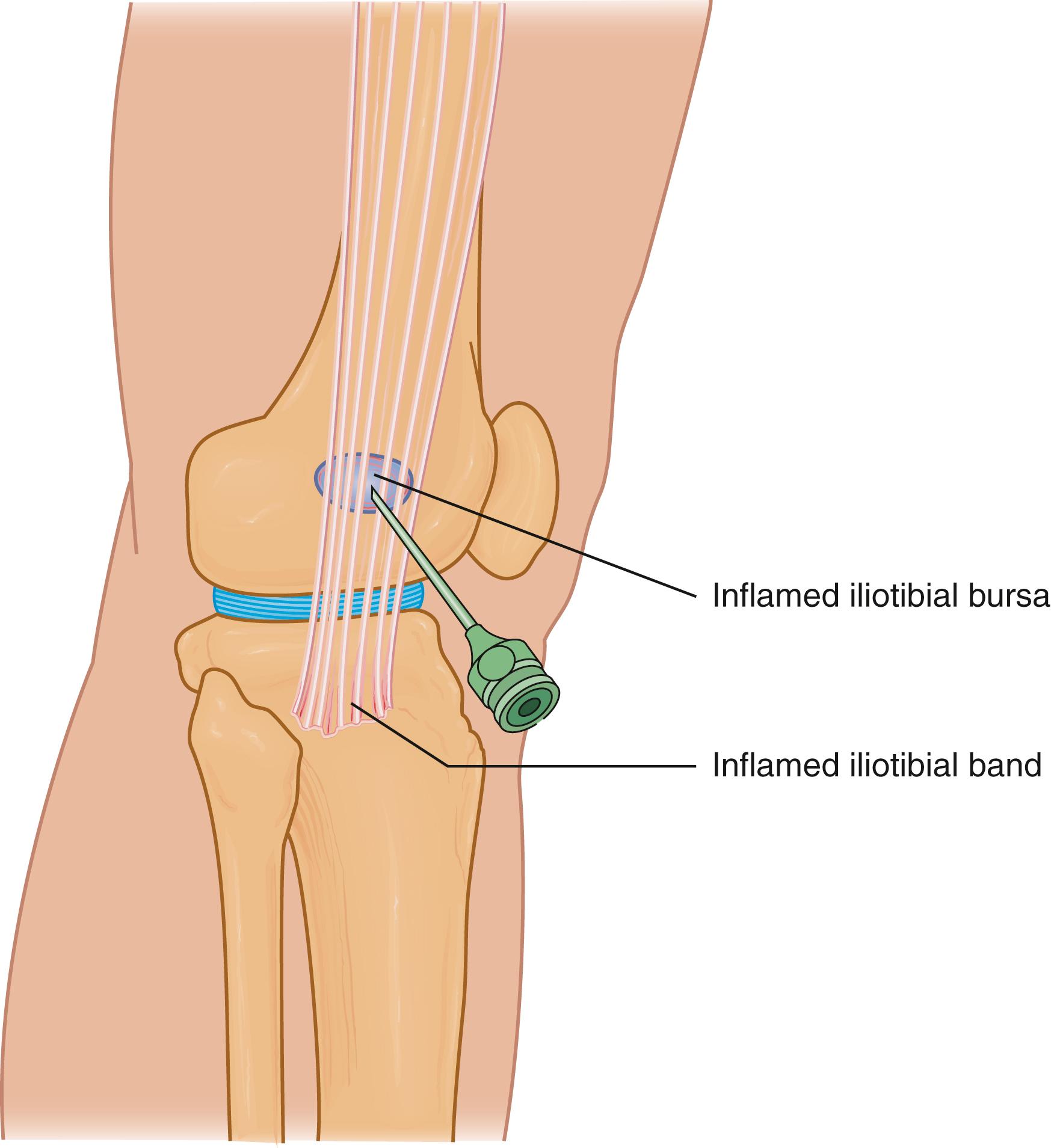 FIG. 162.1, Proper needle position for iliotibial band bursa injection.