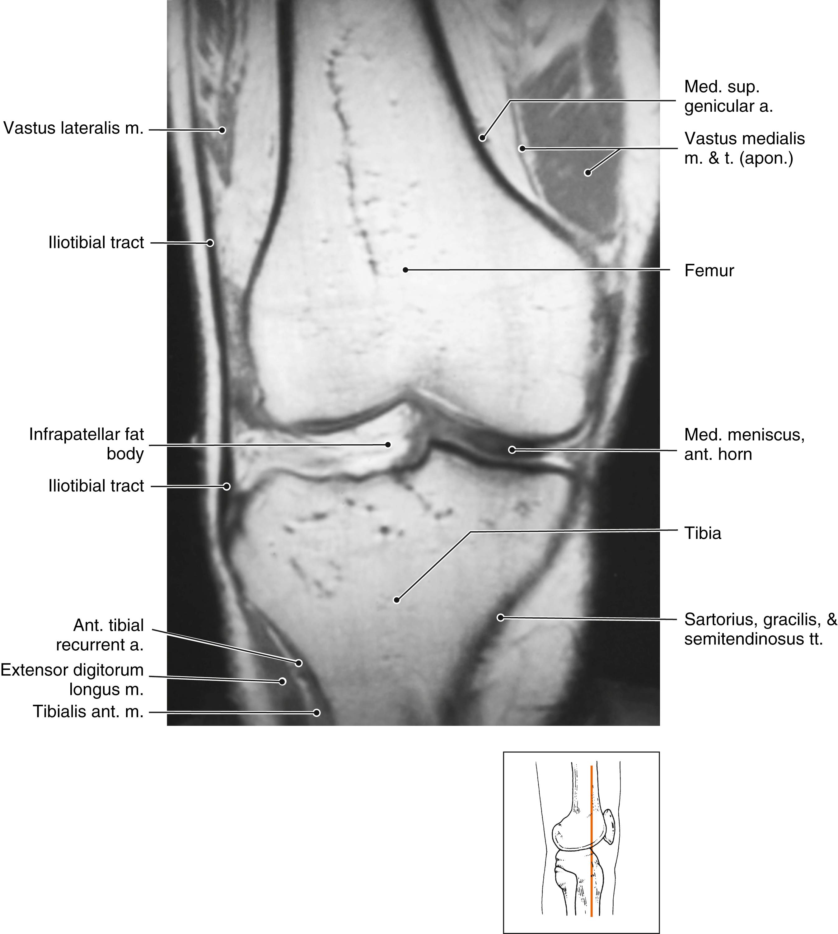 FIG. 162.2, Anatomy of the iliotibial band and adjacent structures. a., Artery; ant., anterior; apon., aponeurosis; m., muscle; med., medial; sup., superior; t. / tt., tendon/tendons.