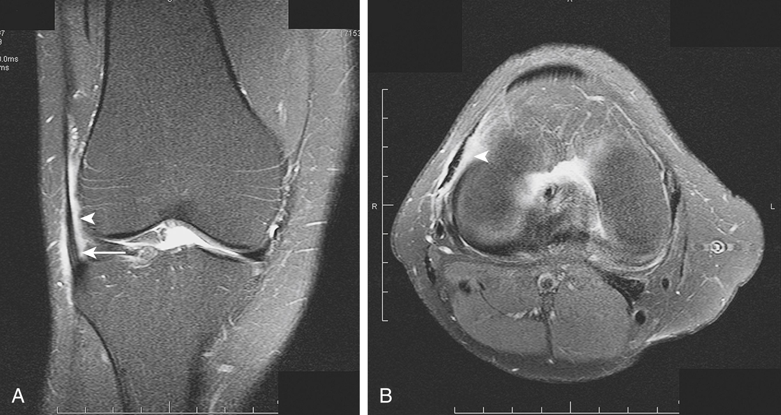 FIG. 162.4, Iliotibial band friction syndrome. A, Coronal T2 fat-saturated image demonstrates high signal intensity in the fatty tissue deep to the iliotibial band (arrowhead) with loss of definition of the normally low signal-intensity band (arrow). B, Axial T2 fat-saturated image demonstrates high signal intensity in the fatty tissue deep to the iliotibial band consistent with replacement by inflammatory tissue (arrowhead).