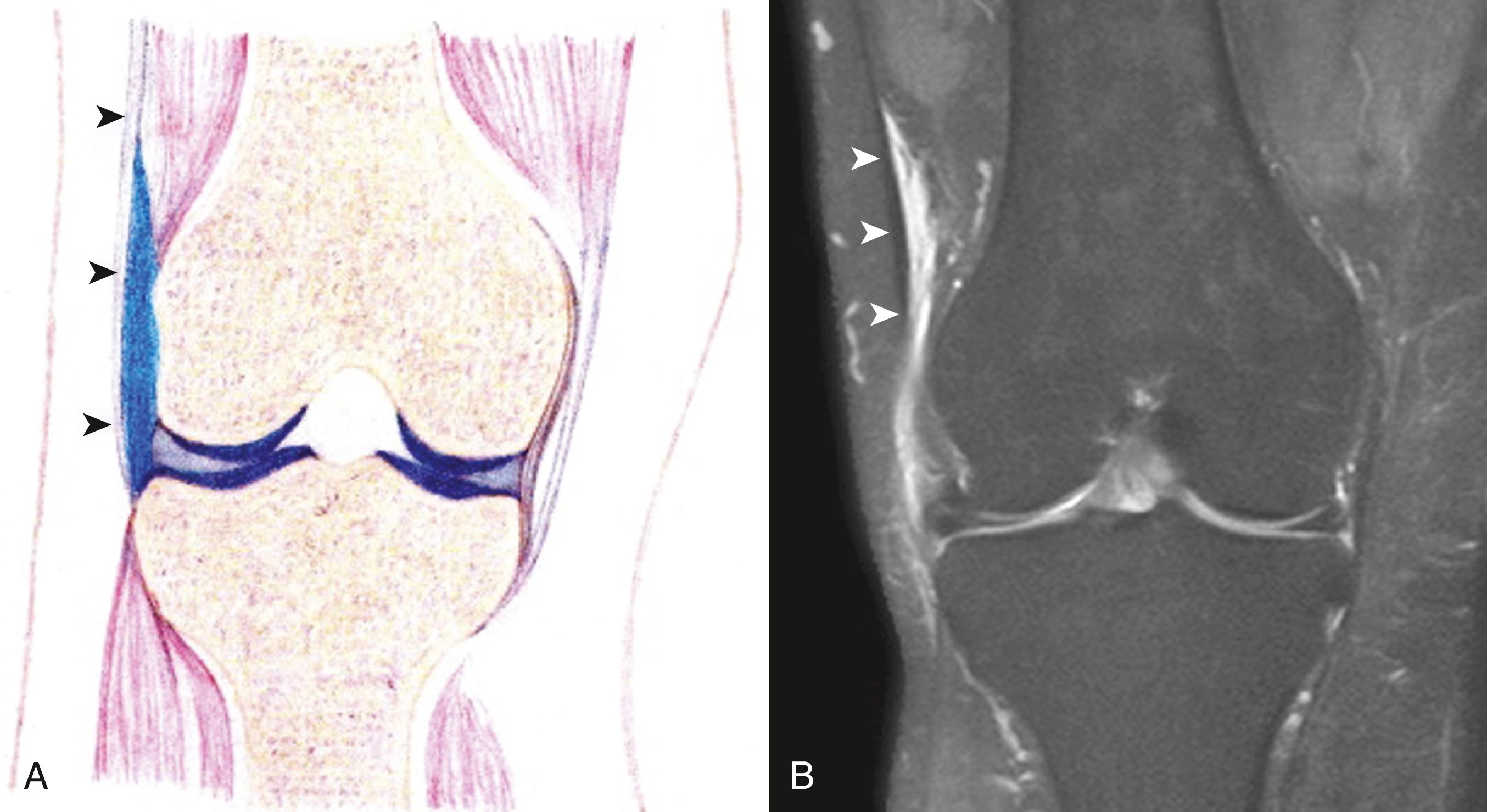 FIG. 162.5, A, Drawing of an iliotibial bursitis. This coronal view demonstrates a fluid collection within the iliotibial bursa (blue), located medial to the iliotibial band (arrowheads). B, Coronal proton density-weighted magnetic resonance image with fat suppression demonstrating a fluid collection located medial to the distal iliotibial band (arrowheads), consistent with iliotibial bursitis.