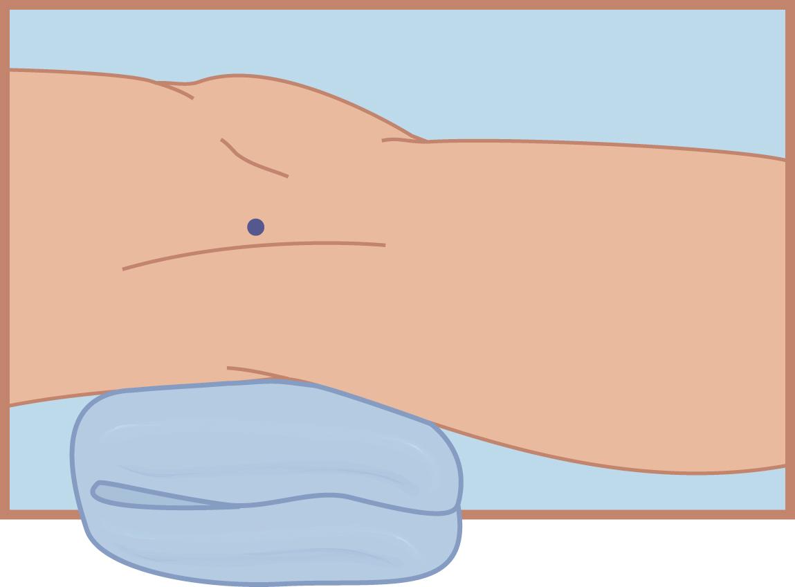 FIG. 162.6, Needle entry site for iliotibial band bursa injection.