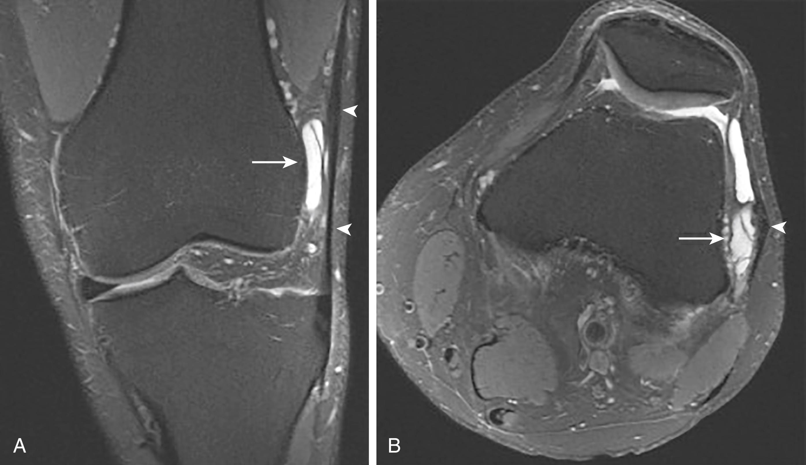 FIG. 162.7, Coronal (A) and axial (B) proton-density fat-saturated images in a long-distance runner with lateral knee pain demonstrate a focal septated fluid collection (arrow) between the iliotibial band (arrowheads) and lateral femoral condyle, compatible with an adventitial bursa.