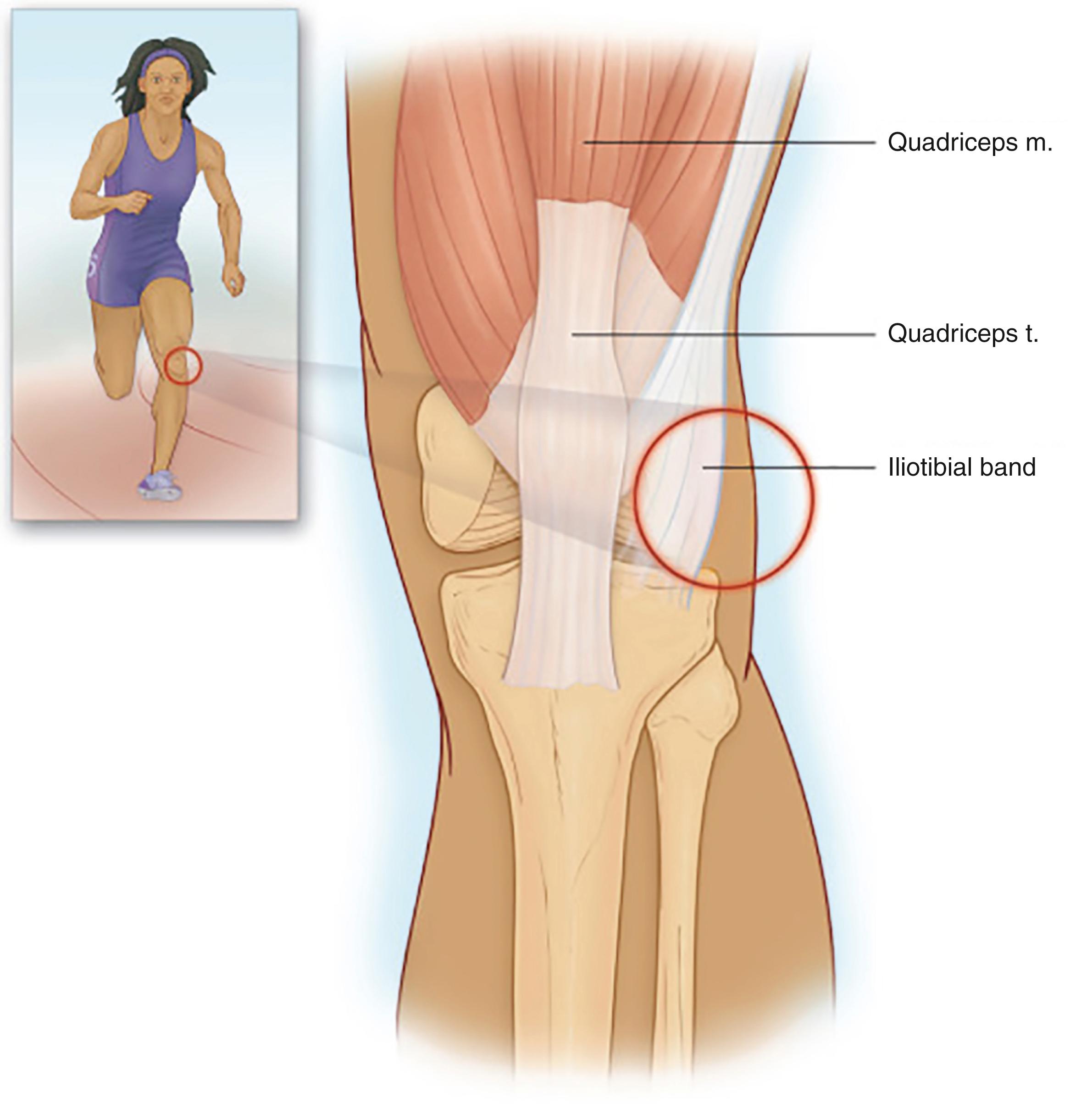 FIG. 164.3, Patients with runner’s knee present with pain over the lateral side of the distal femur, just over the lateral femoral epicondyle. The condition is often associated with running or jogging in worn-out shoes