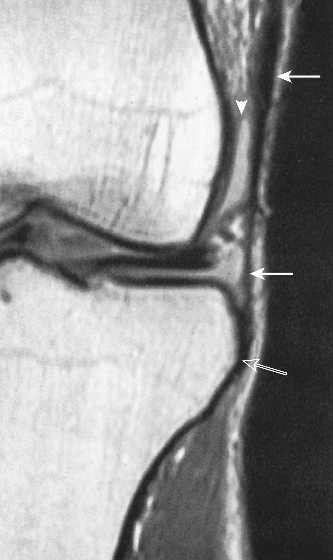 FIG. 164.4, Normal iliotibial tract: magnetic resonance (MR) imaging. A coronal intermediate-weighted (repetition time/echo time, 2000/20) spin-echo MR image shows the iliotibial tract (solid arrows) attaching to the Gerdy tubercle (open arrow) in the tibia. A small joint effusion is evident just medial to the iliotibial tract (arrowhead).