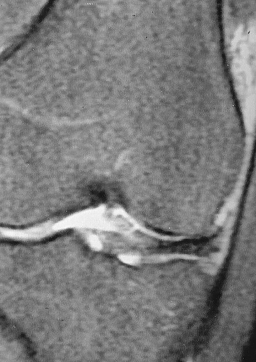 FIG. 164.6, Iliotibial tract syndrome: magnetic resonance (MR) imaging. This coronal fat-suppressed fast spin-echo (repetition time/echo time, 2500/42) MR image shows an abnormal, poorly defined region of high signal intensity deep to the iliotibial tract.