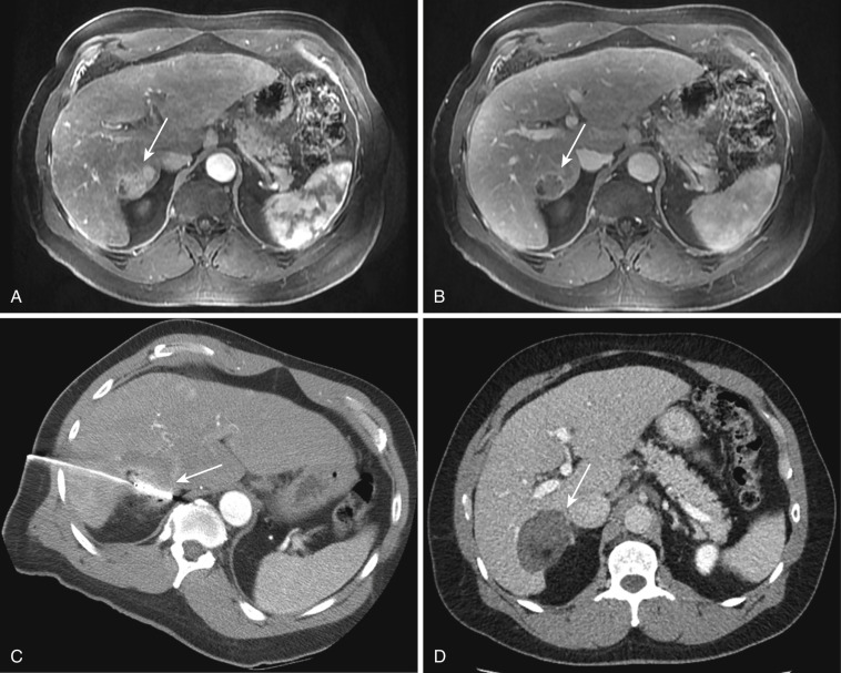 FIG 69-1, Achieving an ablative margin. Images of a 63-year-old woman with cirrhosis and lobulated right hepatic lobe tumor with arterial enhancement ( A ) and contrast washout on delayed-phase MRI ( B ). C, Microwave probe positioned within the tumor. D, Contrast-enhanced CT at 1-month follow-up demonstrates hypoenhancing well-marginated ablation zone encompassing the tumor and a 1-cm ablative margin. An adequate ablation zone should always be larger than the original tumor on follow-up imaging.