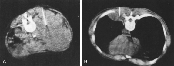 FIG 67-3, A, First CT-guided biopsy was of a retroperitoneal mass (by the author). Although the results of this biopsy were negative, the merits of CT guidance were obvious. B, First CT-guided procedure of the lung in 1975 (by the author).