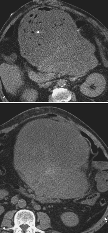 FIG 67-13, A, Patient with a mesenteric mucoid mass that was biopsied using a transenteric approach. CT scan shows mass in peritoneum (arrow), which was biopsied with the needle inadvertently, traversing the bowel loop. B, After several days the patient developed a severe fever and elevated white blood cell count. CT scan shows air in the mass indicating secondary infection.