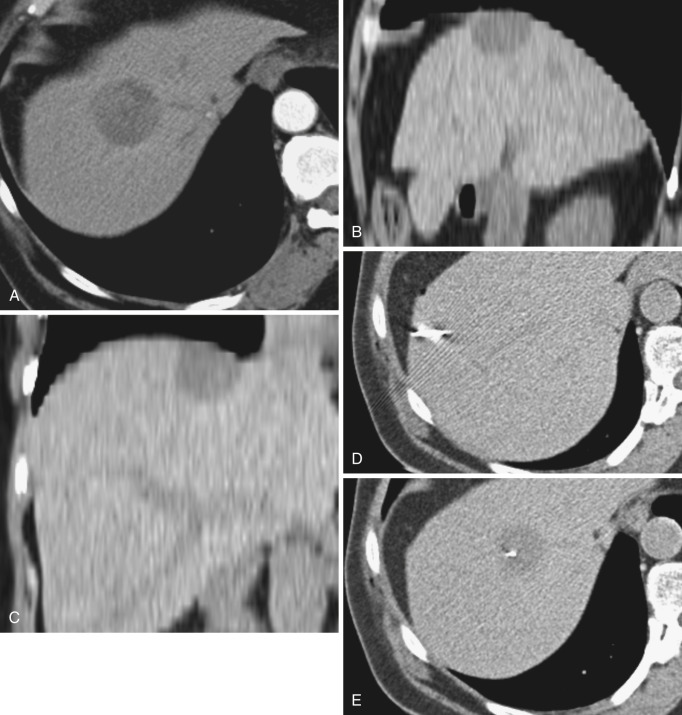 FIG 67-14, A, Reconstructions can be worthwhile for assessing the location of masses and determining the angulation required. This axial scan shows a central lesion very high in the liver. B, Sagittal image shows the lesion close to the diaphragm. C, Coronal image shows the very high location of the lesion and most importantly the insertion of the diaphragm. By using an entrance site in the midaxillary line, the pleural space can be avoided. Although some authors have used the transpleural approach for high liver lesions, there is a higher incidence of pneumothorax and possible tumor seeding of the pleura. The literature regarding traversing of the diaphragm is comforting, but the best approach is to avoid such issues. D, CT scan shows the lowest insertion of the needle angled cephalad. E, Scan shows the tip of the needle at the margin of the lesion.