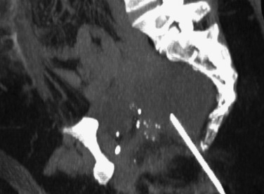 FIG 67-15, Sagittal view during rectal drainage of abscess shows the needle directed into the pelvic abscess.