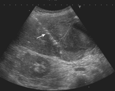 FIG 67-17, Real-time US showing needle puncture of the gallbladder (arrow) during cholecystotomy.