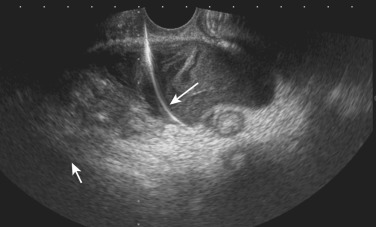 FIG 67-18, US showing placement of wire and catheter (arrow) into the pelvic abscess.