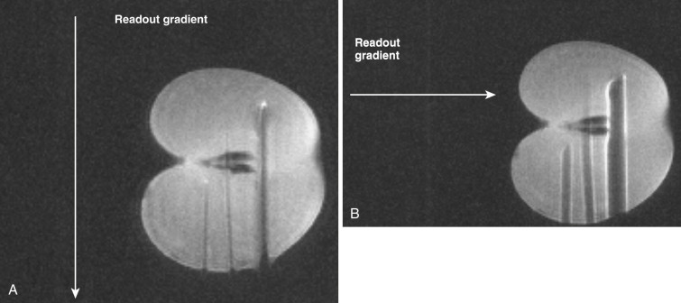 FIG 67-19, These two sets of images show the importance of properly orienting the readout gradient to the alignment of the needles. A, This image shows various-sized needles within an apple with the gradient parallel to the needles. Note how visualization of the needles is lessened by the apparent thin diameters of the needles. B, This set of images of the same needles in the same apple shows the diameter of the needles as being very large, enhancing their visualization. Localization of the needle tip is more accurate with the gradient perpendicular to the orientation of the needles than with the gradient parallel. This was well shown by Lewin and colleagues. 297