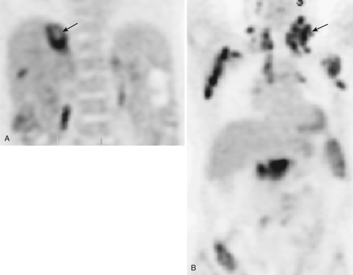 FIG 67-20, A, PET study shows multiple locations of lymphoma (arrow), providing a geographic distribution for possible target selection. B, PET study shows a necrotic center (arrow) indicating nonviability. Any biopsy should avoid the necrotic center.