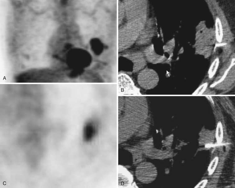 FIG 67-21, Male patient with recurrent squamous cell carcinoma in left lung. A, PET scan with FDG with standard technique shows a large area of intense uptake in the left chest. Note eccentric uptake lateral to a large mass, corresponding to the needle location in B . B, CT scan of the left lung shows a large mass (arrow) adjacent to the left pleura. It appears to show a mass with adjacent infiltrate medially, but the lateral portion appears to be solid tumor. The biopsy needle is seen at the edge of the mass, corresponding to the edge of intense area on PET scan. Biopsy was negative for cancer. C, Repeat FDG PET following oral pseudoephedrine. Note the reduction in size of the overall mass, with resolution of the small focal hot spot noted in A . From this scan, it was decided that the tumor was more medial in location, which was used to plan second biopsy. D, Repeat CT scan taken during the performance of the repeat biopsy. Note that the needle tip was positioned more medially in the mass. Pathology was positive for squamous cell cancer.