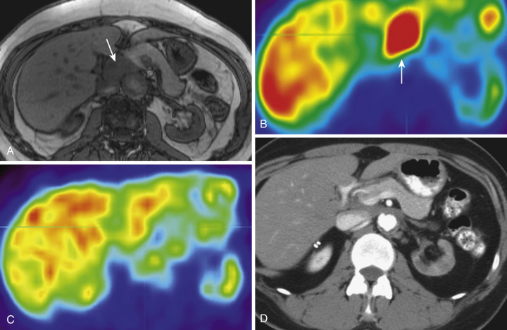 FIG 67-22, Female patient with history of hepatitis C. A, MRI scan shows a large solid mass (arrow) in the porta hepatis suspected to be a metastatic lymph node. Because of the location, percutaneous biopsy was not possible. B, PET image obtained using standard technique shows a large area of intense uptake (arrow) in the porta hepatis. C, PET study performed 5 days later with oral ingestion of pseudoephedrine 60 mg (oral phenylephrine 10 mg may also be used) before FDG injection. Scan shows an absent area of uptake. D, CT scan 6 weeks later shows resolution of lymph node mass, supporting the premise that the mass was inflammatory. The patient declined surgery.