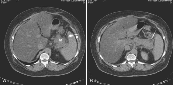 FIG 67-23, A, Scans adjacent to a mass (M) in the tail of the pancreas shows the close proximity of varices (arrow) in the gastrosplenic ligament. B, With the patient in an oblique position and an angled approach, aspiration needle biopsy of the pancreatic mass avoiding the colon, spleen, and varices was accomplished. In contrast to other authors who recommend traversing uninvolved organs, we recommend that one at least attempt to avoid them. In most cases, penetration can be avoided. Over a large series of procedures, the absolute number of complications would be less because at least a relatively smaller number of inadvertent penetrations would occur.